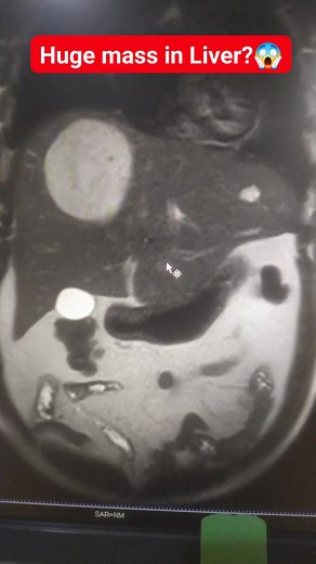 A huge mass lesion is found in liver during MRCP #MRI #radiology #radiographer #medical #MRCP #RadiologyLife #radiography #mriscan #mritech | Maruf Bhuiyan The Radiographer