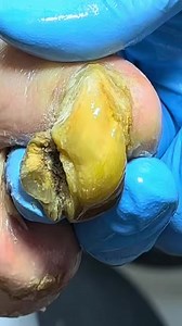 Pedicure for Curled Toenails with Fungus Build-Up and Treatment Solutions N205 #ingrowntoenail #pedicure #nail #nailcare #ingrownnail Disclaimer: This video contains clips collected from various sources. Full credit goes to the original Chinese creators. This content is used for educational and monetization purposes only. All rights belong to their respective owners. | Finatic Gaming