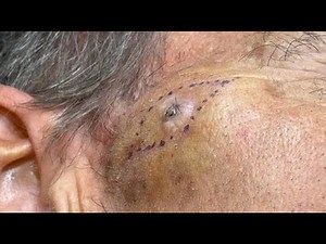 Removal of a squamous cell cancer on the face