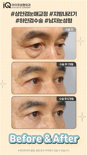 상안검, 하안검수술, 처진 눈매를 다시 또렷하게 👀
