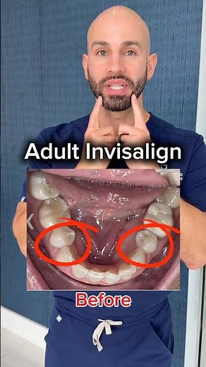 Adult Invisalign Before and After: Narrow Smile to Wider Smile