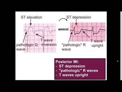 Posterior MI: EM in 5 | Dr ANURAG AGGARWAL