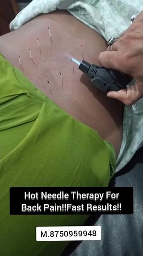 Hot Needle Therapy For Back Pain!!Fast Results!!