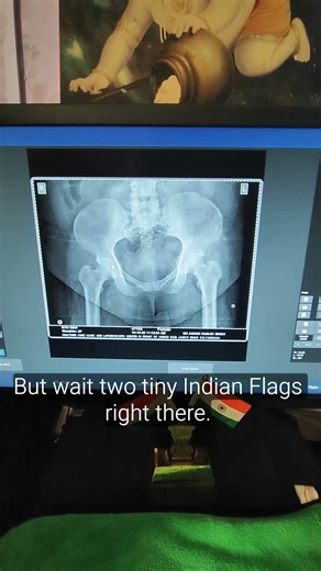 Untitled PELVIS AP XRAY VIEW 🩻