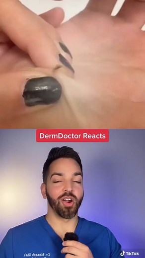 Hand pimple?! #dermdoctor #pimplepopping | hand pimples