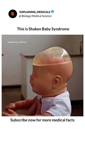 Abusive Head Trauma (AHT) in babies#ShakenBabySyndrome #AbusiveHeadTrauma #SBSPrevention #medical