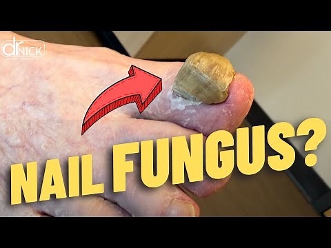 Cutting a Giant Thick Toenail (Satisfying Removal)