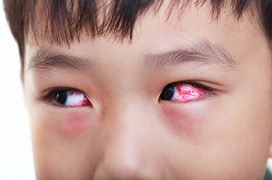 What is Conjunctivitis?