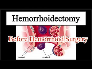 Hemorrhoidectomy | Hemorrhoid Surgery | Hemorrhoid removal #hemorrhoidectomy #hemorrhoids #bastrop