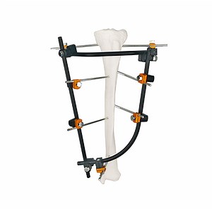 [Hot Item] Advanced Orthopedic External Fixator for Joint Fracture Repair