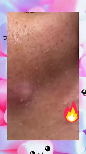 pimple popping abscess acne squeezeuk viral satisfying (200)