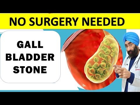 No Pain No Surgery Needed | Asymptomatic Gall Bladder Stone Treatment | Dr.Education