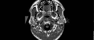 MRI radiology scan of the human brain head anatomy, for medical diagnosis at a lab