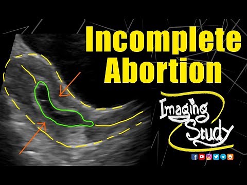 Incomplete Abortion || Ultrasound || Case 180