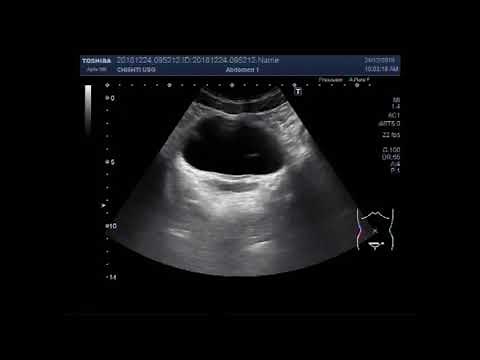Ultrasound Video showing a prostatic utricle cyst.
