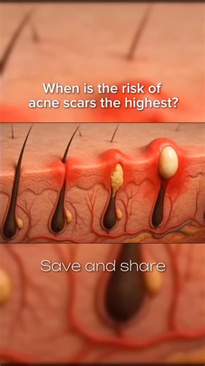 Cystic acne doesn’t always “go away.” When it forms, the damage happens deep in the skin - in the dermis. Once that layer is injured, the skin can’t fully return to how it was before. Here’s the honest truth: scars can’t be erased. Not with skincare. Not with treatments. They can be softened, smoothed, and made much less noticeable — but they can’t be completely removed. That’s why treating acne early matters. Before inflammation reaches and damages the deeper layers of the skin. Save this. Shar