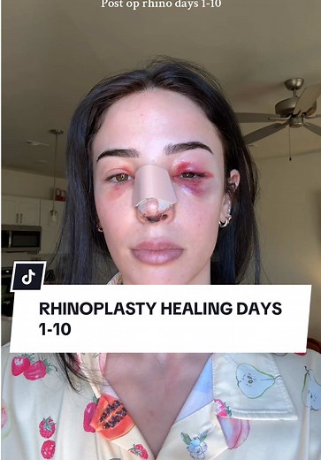 Rhinoplasty Healing Process: Days 1-10 Insights