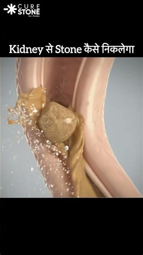 Why kidney stones do not come out #urology