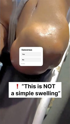 Suspicious Shoulder Mass on Ultrasound #shorts