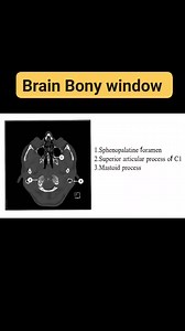 5.9K views · 54 reactions | #bonewindow #brainct #CTBrain Brain Bone Window Full anatomy | CT Scan and MRI study | Facebook