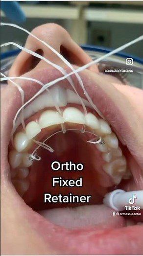 Lingual Retainer wire