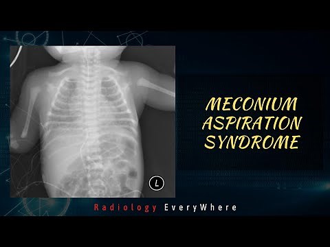Meconium Aspiration Syndrome | Radiology Everywhere | Chest x-ray