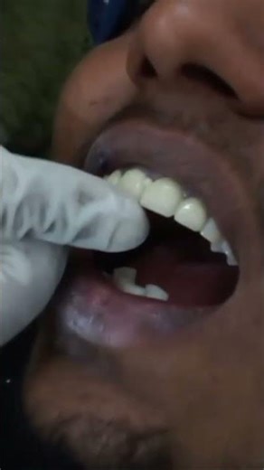 CAPPING OF TEETH#teeth#dentist#doctor#teethcleaning#scaling#dentalhygiene#treatment#smile#shorts🦷