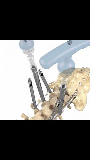 Spinal Fixation 3D Spine Implant Animation by Pulse 3D Media #3dmedicalanimation #pulse3dmedia