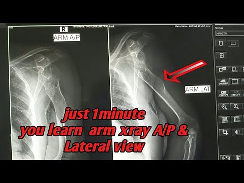 Xray of arm a/p & lateral view.2020 simple discribe of arm xray😊