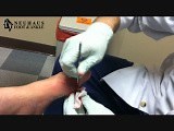 Gout Lesion Drainage - Foot • Video • MEDtube.net