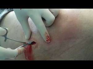 Big Abscess on the Leg .Большой абсцесс бедра