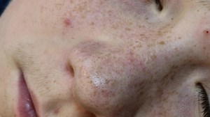 Beste Arbeit der Welt🤘😅 #mitesser #pickel #ausreinigung #blackhead #eiterpickel #nase #unreinheiten #selbstständig #pupertät #pickelloswerden #pickelausdrücken #pickelonfleek