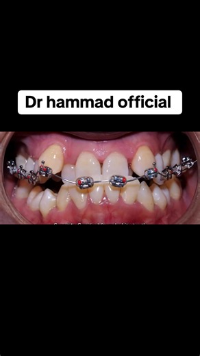 Ortho treatment 🦷 #dr_hammad_official #unfrezzmyaccount #dentistry #100kviews #standwithkashmir