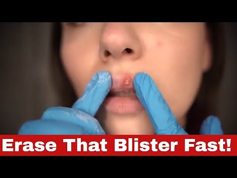 Fast and Effective: How to Get Rid of a Fever Blister in 24 Hours!