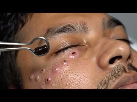 Blackhead Removal Tools Demo | How to Use Them Safely