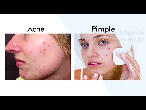 Difference Between Acne And Pimple| Best Skin Care Clinic In Bangalore - Manipal Hospitals