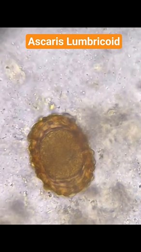 Ascaris Lumbricoid in stool microscopy|roundworm ova in stool slide | Parasitology | #microbiology