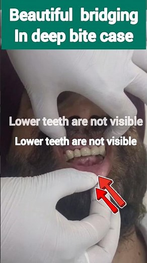 Deep bite case- difficult bridging done with CAD CAM PFM Bridge #dentalbridge #fixteeth #newteeth