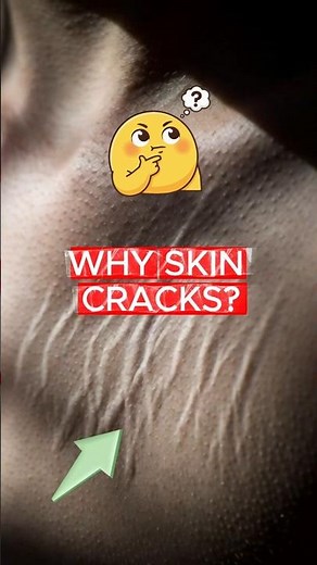 The SHOCKING Truth About Stretch Marks and Skin Cracks