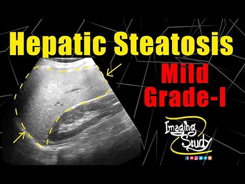 Mild Hepatic Steatosis || Mild Fatty Infiltration || Ultrasound || Case 170