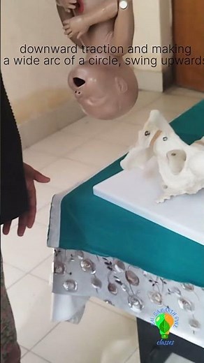 Burns marshall method of assisted breech delievery‪@Profdrshikhapandey‬ #obstetrician