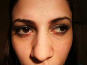 Bilateral Internuclear ophthalmoplegia (INO)