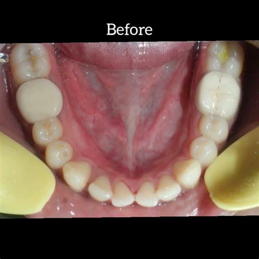Orthodontic Treatment - 23