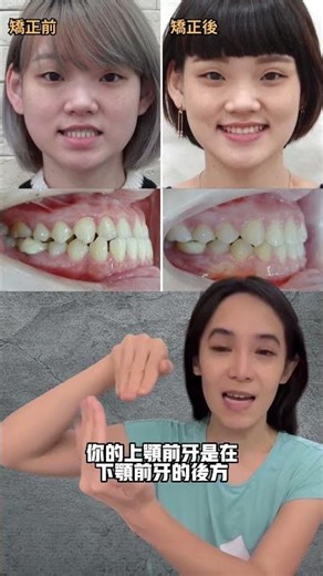 一次看懂所有咬合關係#戴牙套＃反咬＃深咬＃開咬
