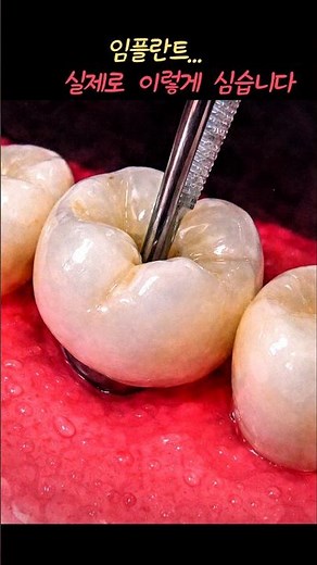 Implant Procedure | Actual Tooth Implantation Process