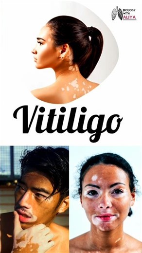 Vitiligo #shortsfeed