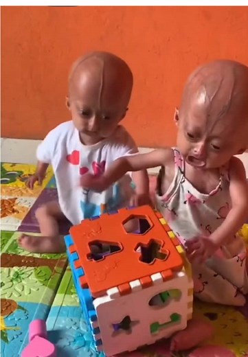 Sisters with Progeria: Elise and Eloa's Journey
