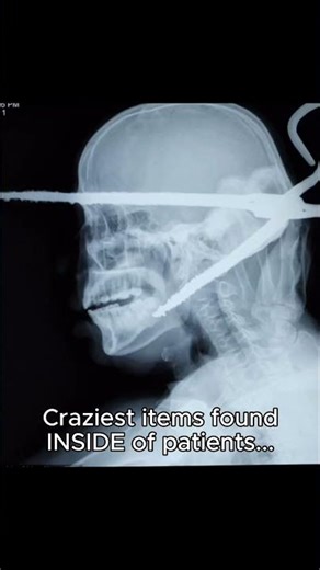 Doctors saw WHAT on these X-rays?! 🤯🩻 #interesting #crazy