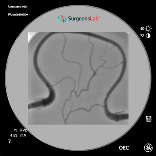 Middle Meningeal Artery (MMA) Simulation Model | SurgeonsLab