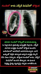 గుండెలో కాదు ఎక్స్‌రే మెషిన్‌లో బొద్దింక #HealthFact #MedicalReality #DidYouKnow #hospitalstory